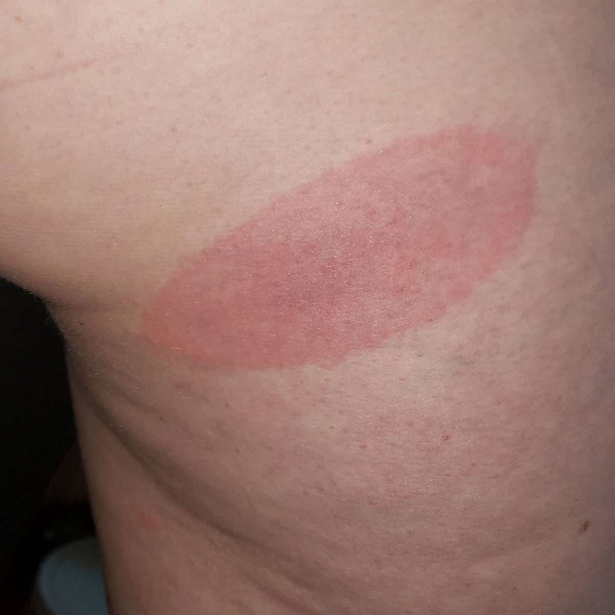 Told I have Lyme Disease today at Med Express. Got this rash after 5 ...