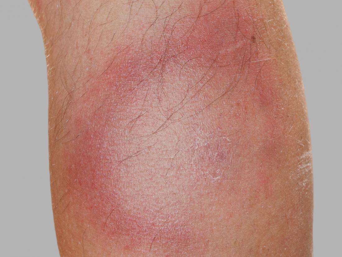 Bulls Eye Rash Lyme Disease Pictures