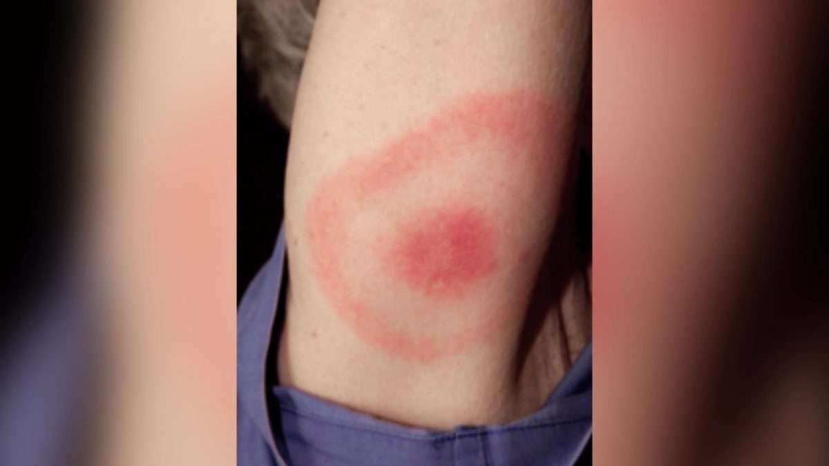 Early detection for Lyme disease