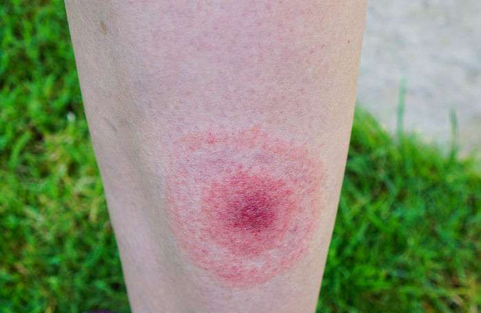 How to check for Lyme disease