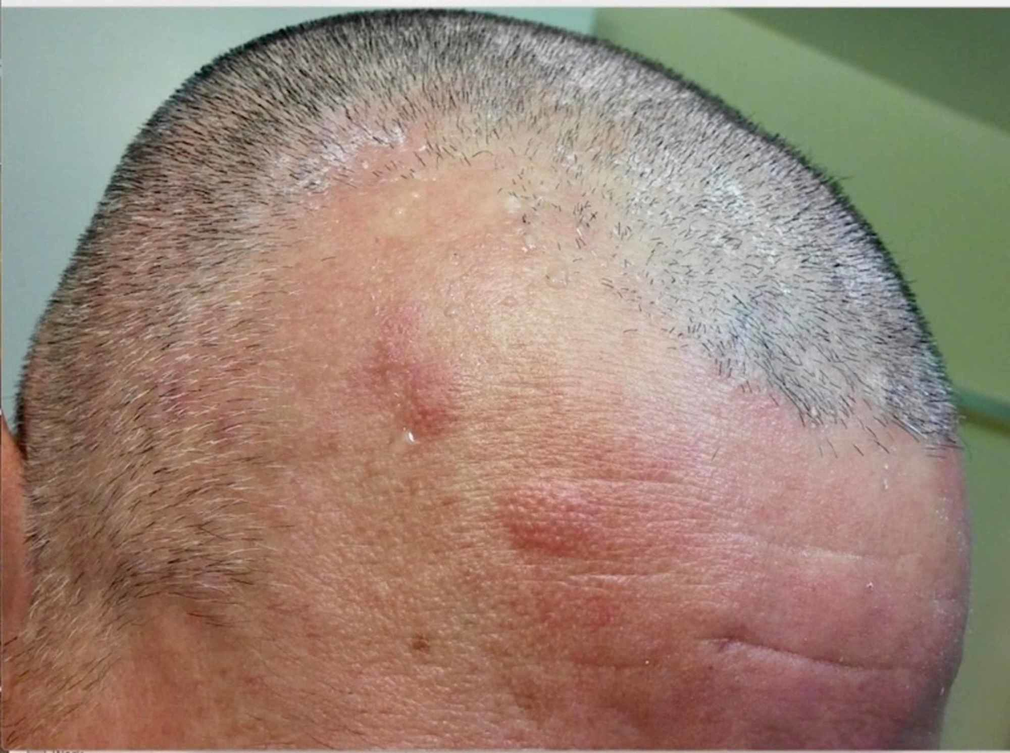 Lyme Disease And Hair Loss