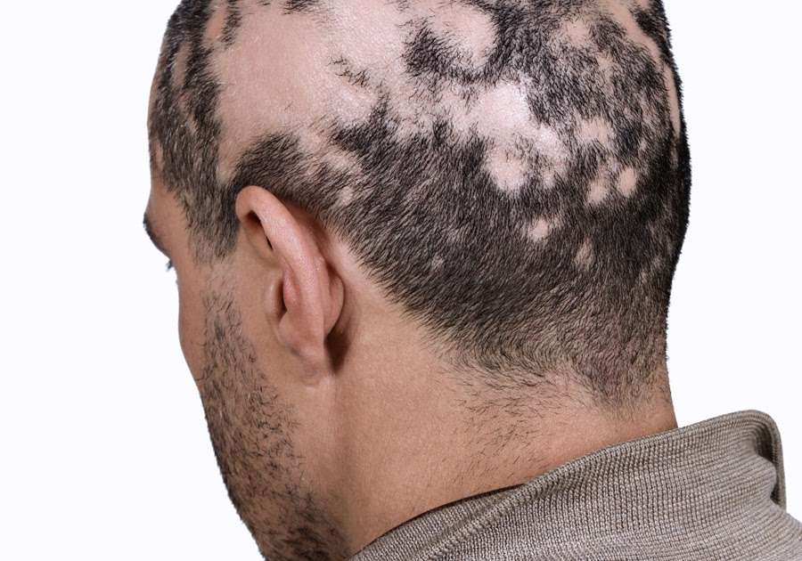 Lyme Disease Hair Loss
