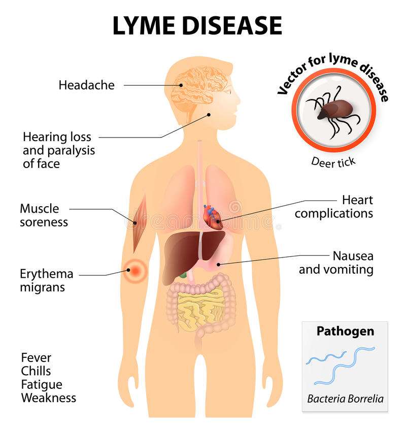 Lyme Disease Or Lyme Borreliosis Stock Vector