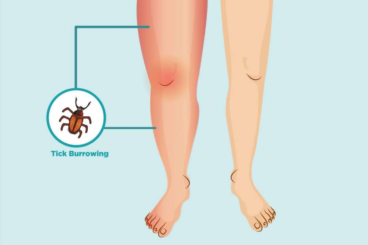 Lyme Disease symptoms causes diagnosis and prevention