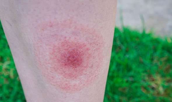 Lyme disease: Top tips for spotting early signs of the condition ...