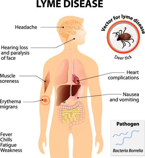 What is Lyme Disease? Facts and Preventive Measures