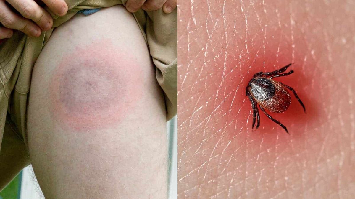 10 Foods That Help You Recover from Lyme Disease