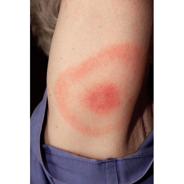 Bullseye Rash for Lyme Disease