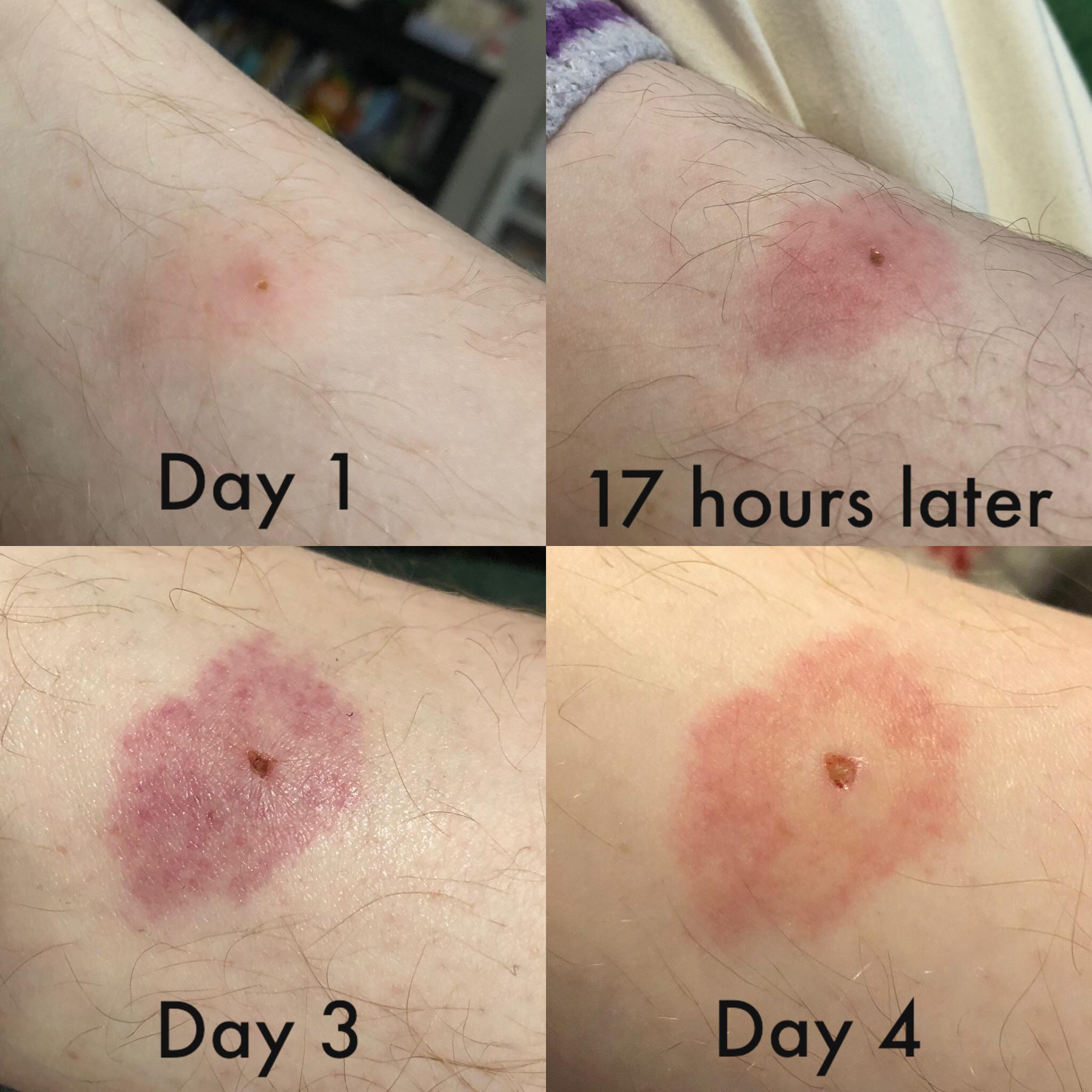 Does this look like a bullseye rash to anyone? Im not really sure. : Lyme