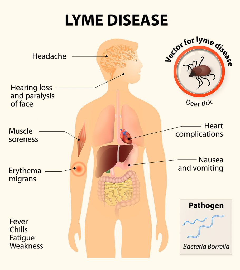 Lyme Disease Early Symptoms In Humans