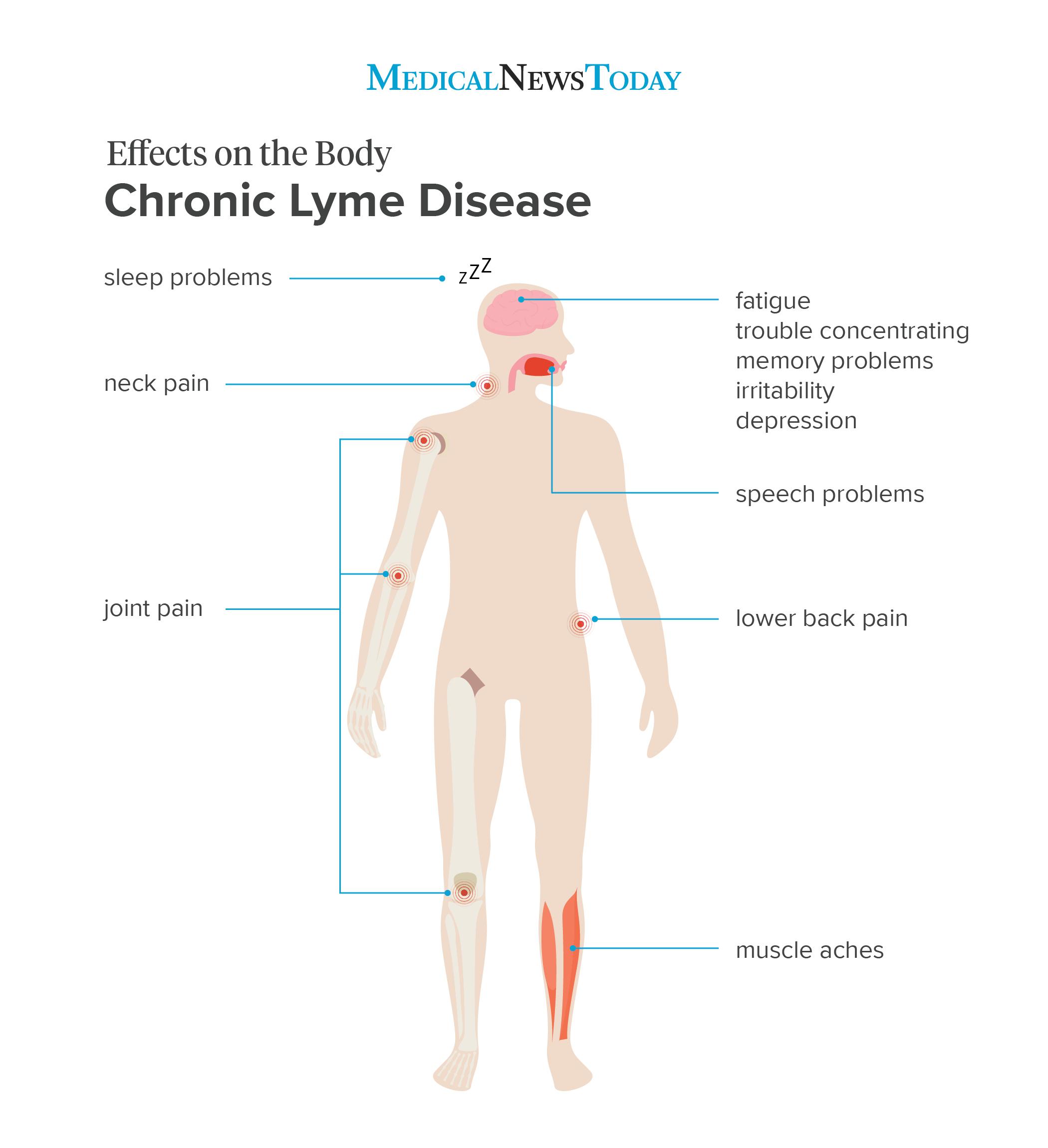 Lyme Disease Swollen Lymph Nodes Neck