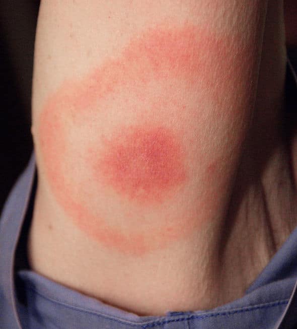 Lyme disease symptoms: Suffering with a stiff neck could be sign of ...