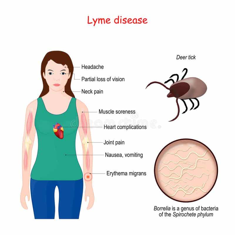 Lyme Disease. Woman with Erythema, Signs and Symptoms Lyme Borreliosis ...