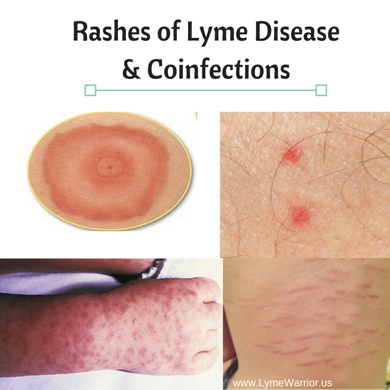 Rashes of Lyme Disease &  Coinfections  Lyme Warrior