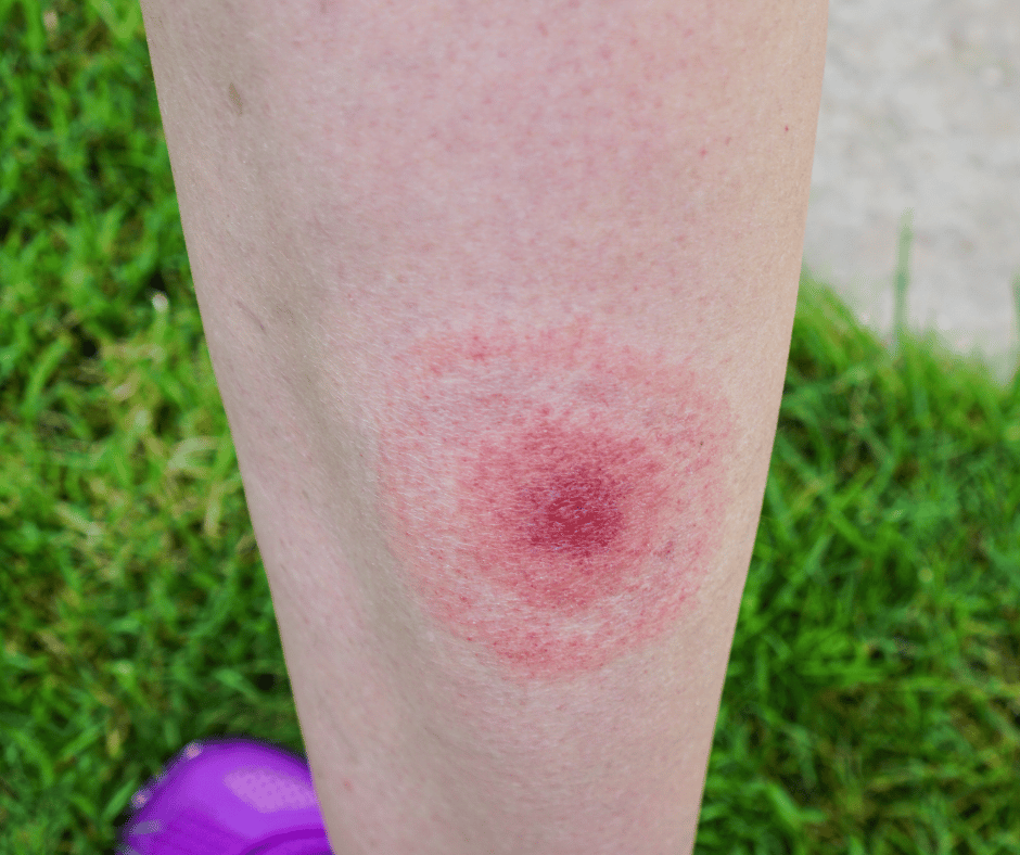 What you need to know about Lyme disease