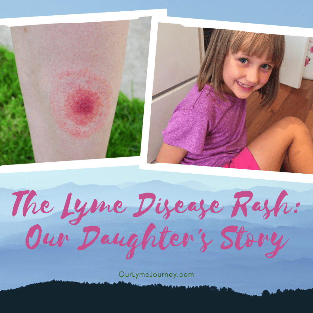 How To Test For Lyme Disease Years Later