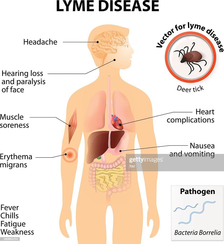 Lyme Disease Or Lyme Borreliosis High