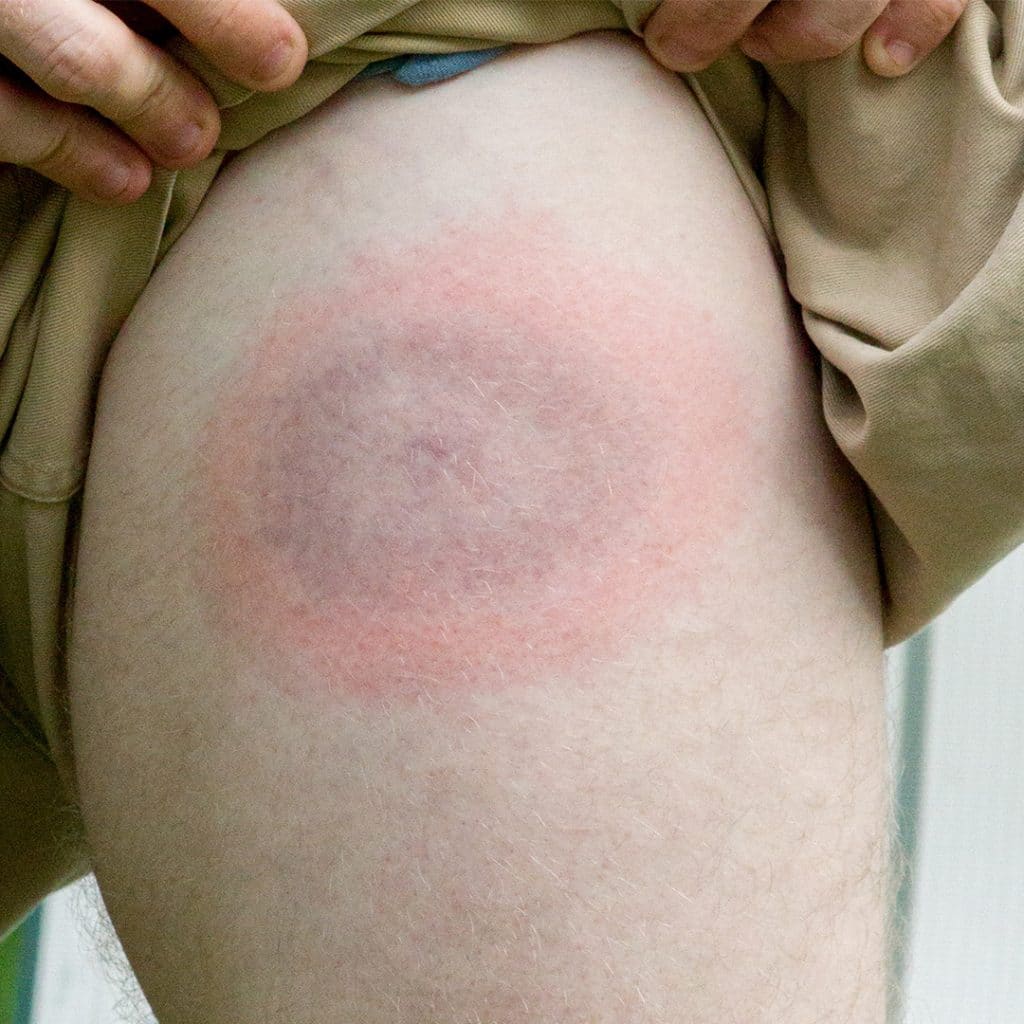 Signs and Symptoms of Lyme Disease · ExtermPRO