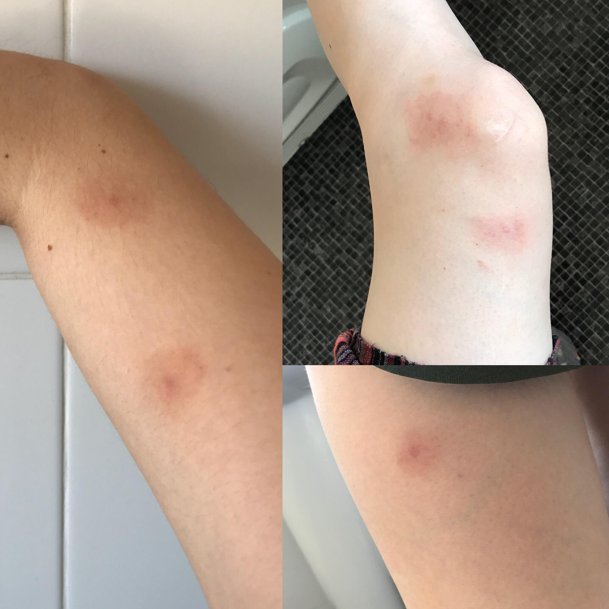 Tick bites/Lyme? Got them about 2 and a half weeks ago and guessing ...