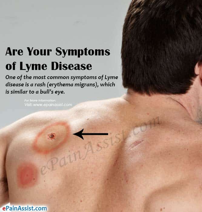 Are Your Symptoms of Lyme Disease?