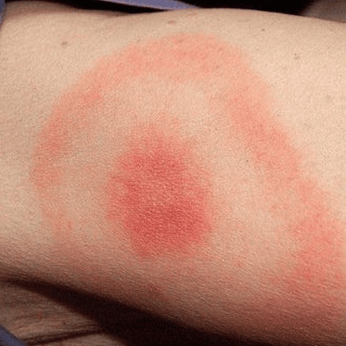 Lyme Disease Rashes