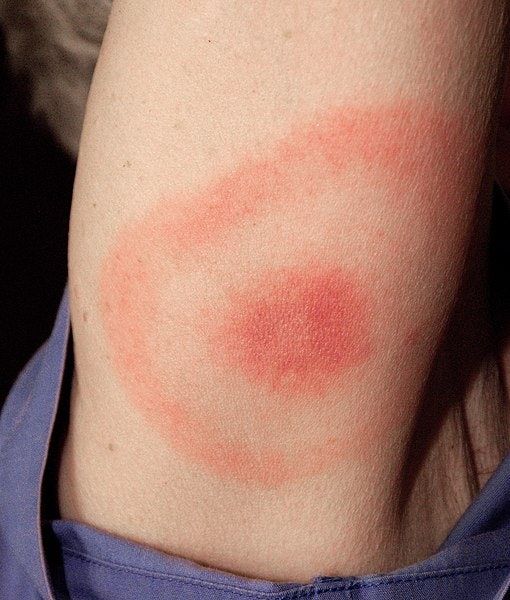 What Is Neurological Lyme Disease? 6 Symptoms You Should Know
